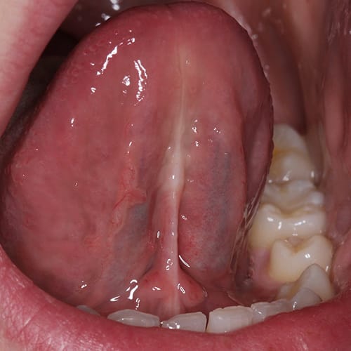 Restricted Lingual Frenulum